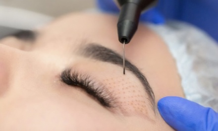 1 sesión de plasma pen (lifting sin cirugía) en manchas, lunar, marca o verruga - Biomimo 1