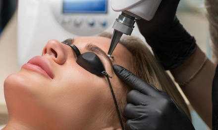 One Laser Tattoo Removal Session for Hair Tattoo (Up to Business Card Size Area) - IVE MEDICAL SPA