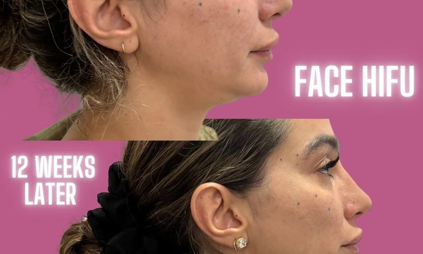Image 5: Revitalize with HIFU Face Treatment for Face with/without Neck