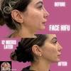 Image 5: Revitalize with HIFU Face Treatment for Face with/without Neck