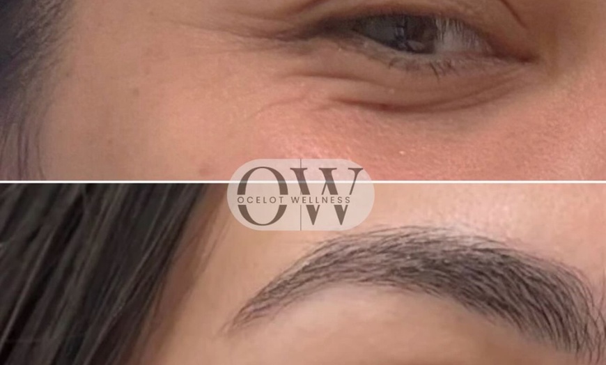 Image 4: Achieve a Refreshed Look with 20, 40, or 60 Units of Botox