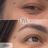 Image 4: Achieve a Refreshed Look with 20, 40, or 60 Units of Botox