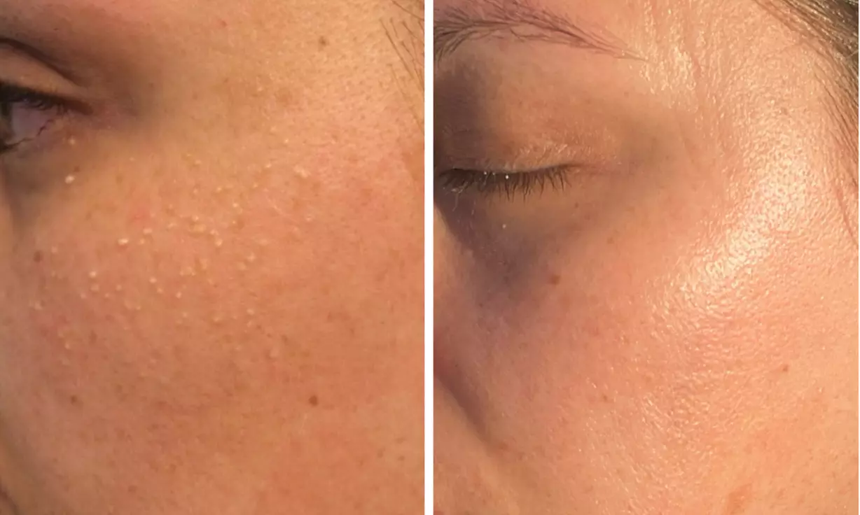 Clear Complexion Acne & Signature Facials for Radiant Skin