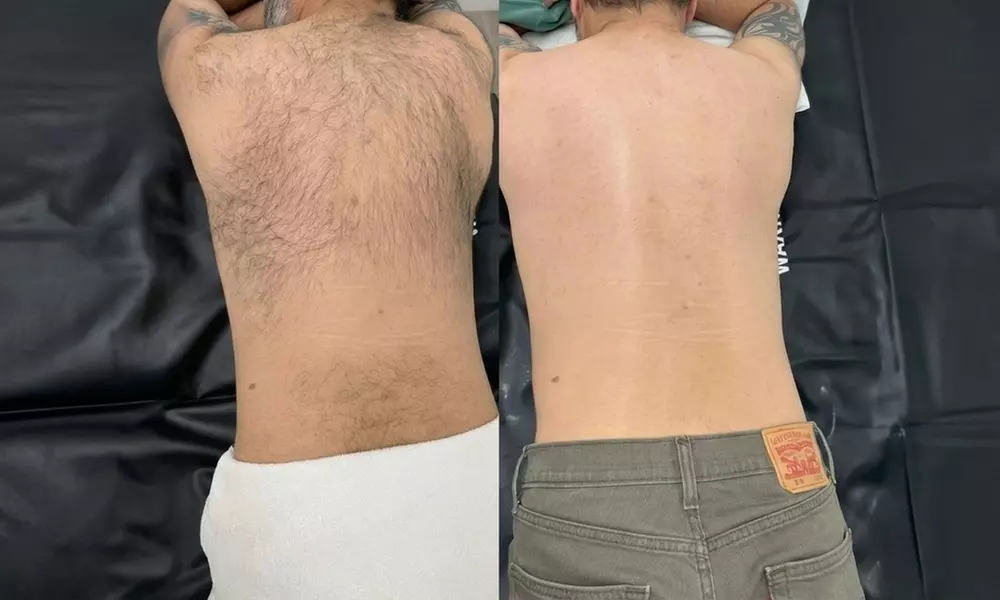 Stoppelvrij door het leven: 3 of 6 keer laserontharingsbehandelingen