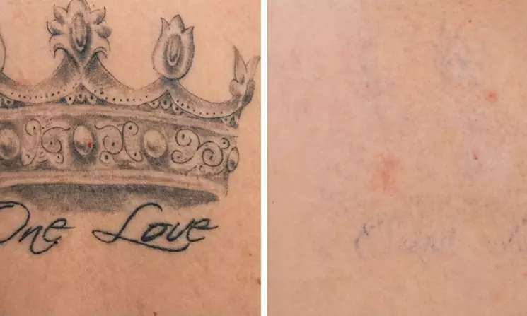 Transform Your Skin with 3 Laser Tattoo-Removal Sessions for Up to 2, 4, or 5 Square Inches (Up to 88% Off) - Second Medium