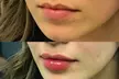 Up to 50% Off on Injection - Dermal Filler at River Oaks Galleria Medspa - Second Medium