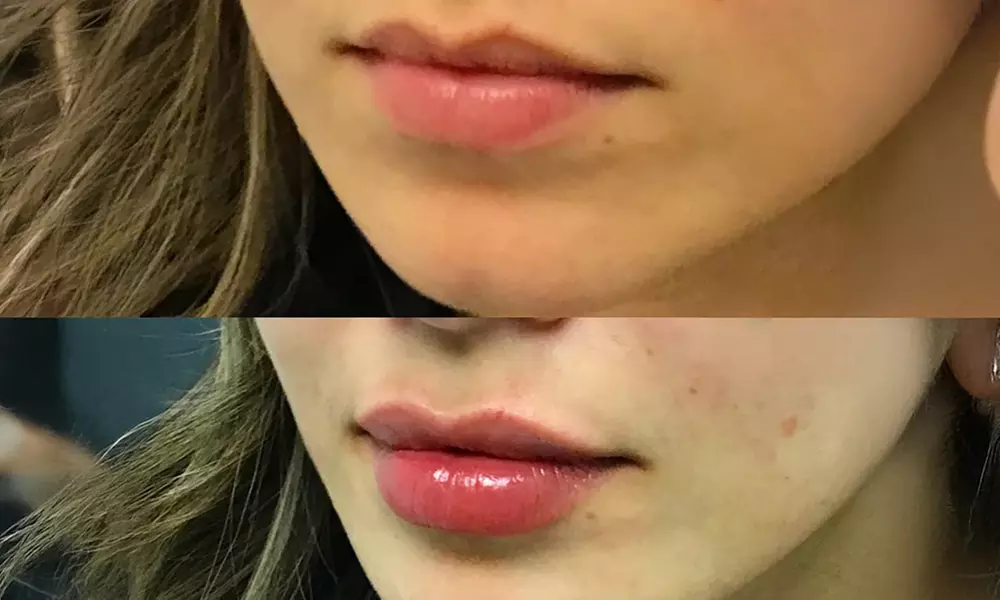 Up to 55% Off on Injection - Dermal Filler at River Oaks Galleria Medspa