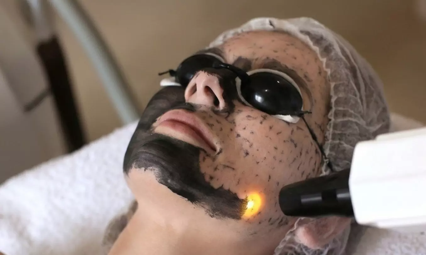 Tratamiento facial Hollywood Peel con mascarilla de carbón activo