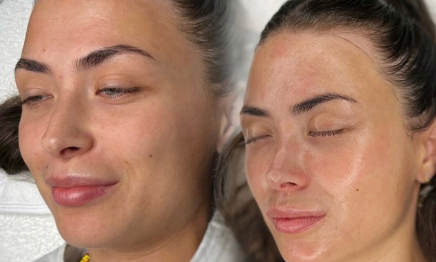 Image 2: Reveal Glowing Skin with One or Two Chemical Peels Session