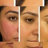 Image 5: Advanced Morpheus8 & PRP Micro needling for Deep Skin Remodeling