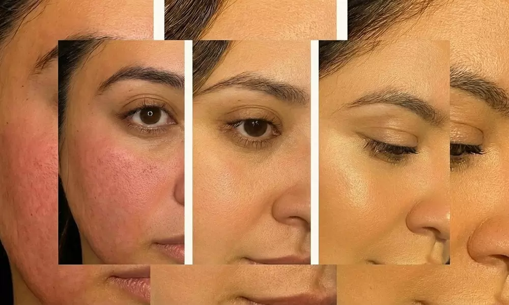 Advanced Morpheus8 & PRP Micro needling for Deep Skin Remodeling