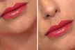 Get 1ML or 2ML Hyaluronic Acid Needle-less Lip Enhancements or Injection at Boho beauty and spa (Up to 30% Off) - Second Medium