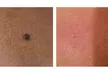 Discover Skin Care New York's effective skin tag, mole, and spot removal with laser tech, offering up to 50% off. - Second Medium