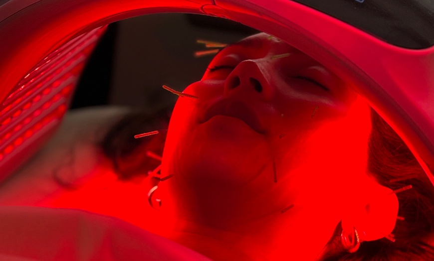 Image 1: First or Facial Acupuncture Session with Initial Consultation