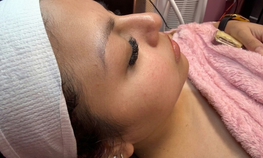 Image 4: Get 50, 100, or 150 Units of Dysport Treatments