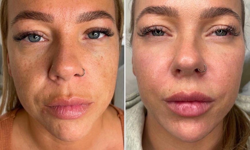 Image 4: Up to 29% Off on Radio Frequency Skin Tightening at GB Luxe Medic