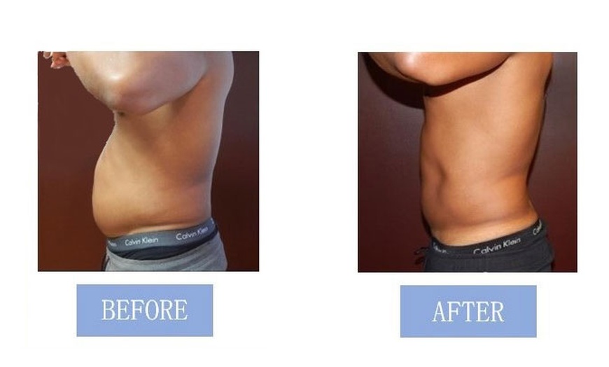 Image 9: Fat Buster or The Works – Body Consultation, Analysis, or More