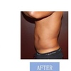 Image 9: Fat Buster or The Works – Body Consultation, Analysis, or More