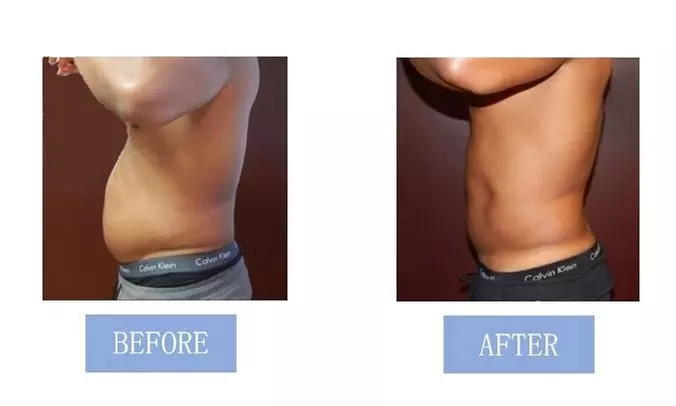 Fat Buster or The Works – Body Consultation, Analysis, or More