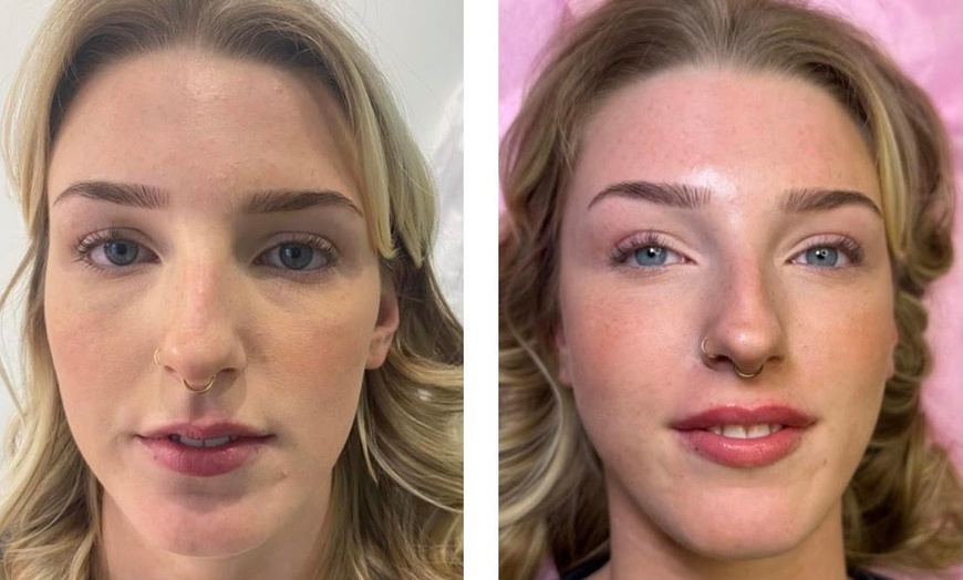 Image 9: Up to 45% Off on Injection Dermal Filler - Eleganza Aesthetics