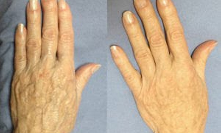 Image 2: Enhance Beauty with Deluxe Hand Rejuvenation! 