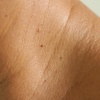 Image 1: Removal of 1, 5, or 10 Skin Tags, Cherry Angiomas, Age Spots, or Warts