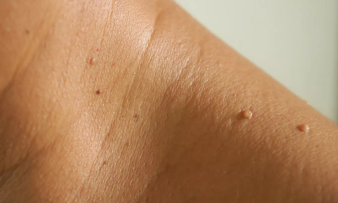 Removal of 1, 5, or 10 Skin Tags, Cherry Angiomas, Age Spots, or Warts