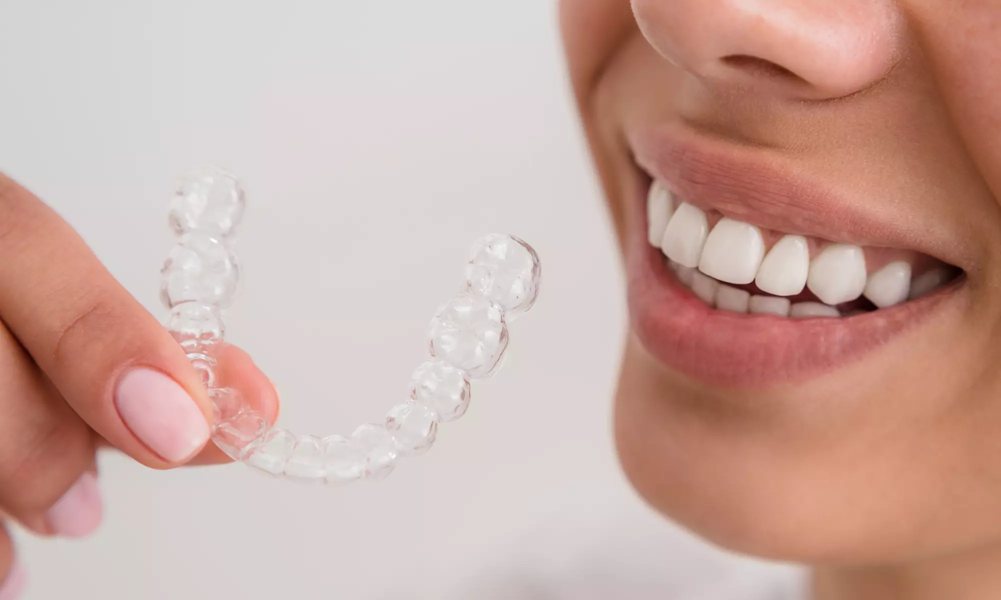 Get All-Inclusive Clear Aligners with Free Whitening Kit