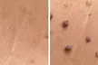 Remove 1–10 Skin Tags, Moles, Warts, Cherry Angiomas Or Milia Up To 2mm Safely & Effectively (Up to 40% Off) - Second Medium