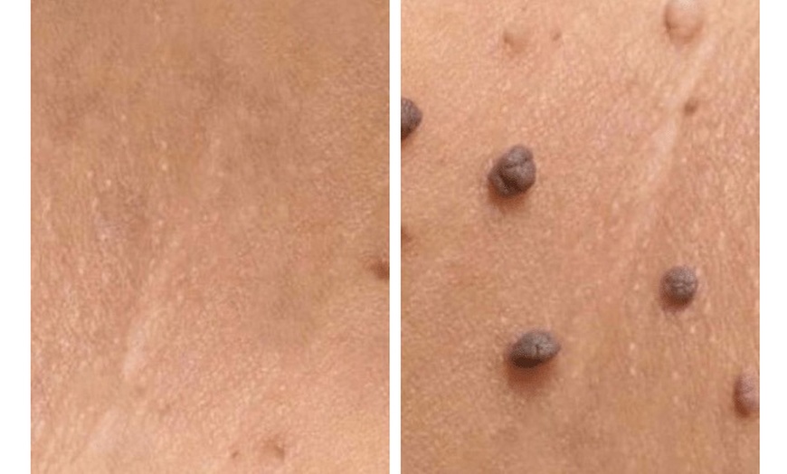Image 2: Remove Up To 10 Skin Tags, Moles, Warts Or Milia Up To 2mm