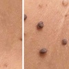 Image 2: Remove Up To 10 Skin Tags, Moles, Warts Or Milia Up To 2mm
