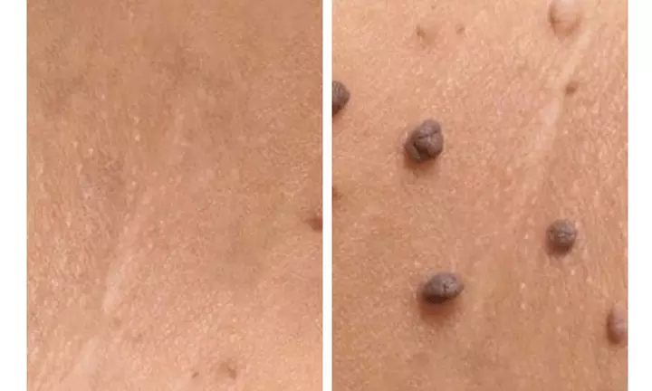 Remove Up To 10 Skin Tags, Moles, Warts Or Milia Up To 2mm