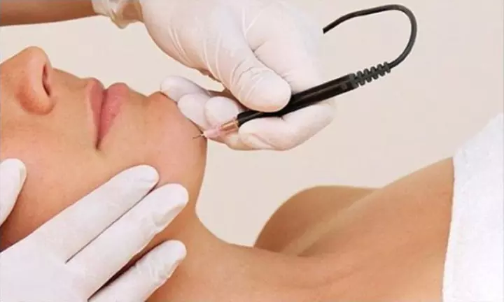 One 15-, 30 or 45-Minute Electrolysis Hair Removal Treatment