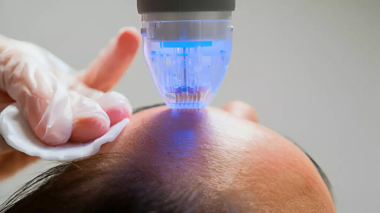 1 of 3 gezichtsbehandelingen, naar keuze met microneedling