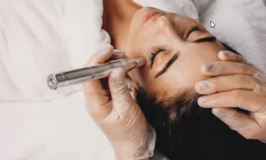 Image 6: One, Three or Six 60-Minute Chemical Peel or Microdermabrasion Facials