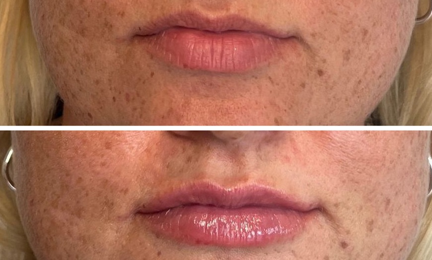 Image 7: 0.5, 1 or 2ml Dermal Filler w/ Consultation: Lip, Smile, Cheek or Chin