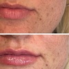 Image 7: 0.5, 1 or 2ml Dermal Filler w/ Consultation: Lip, Smile, Cheek or Chin