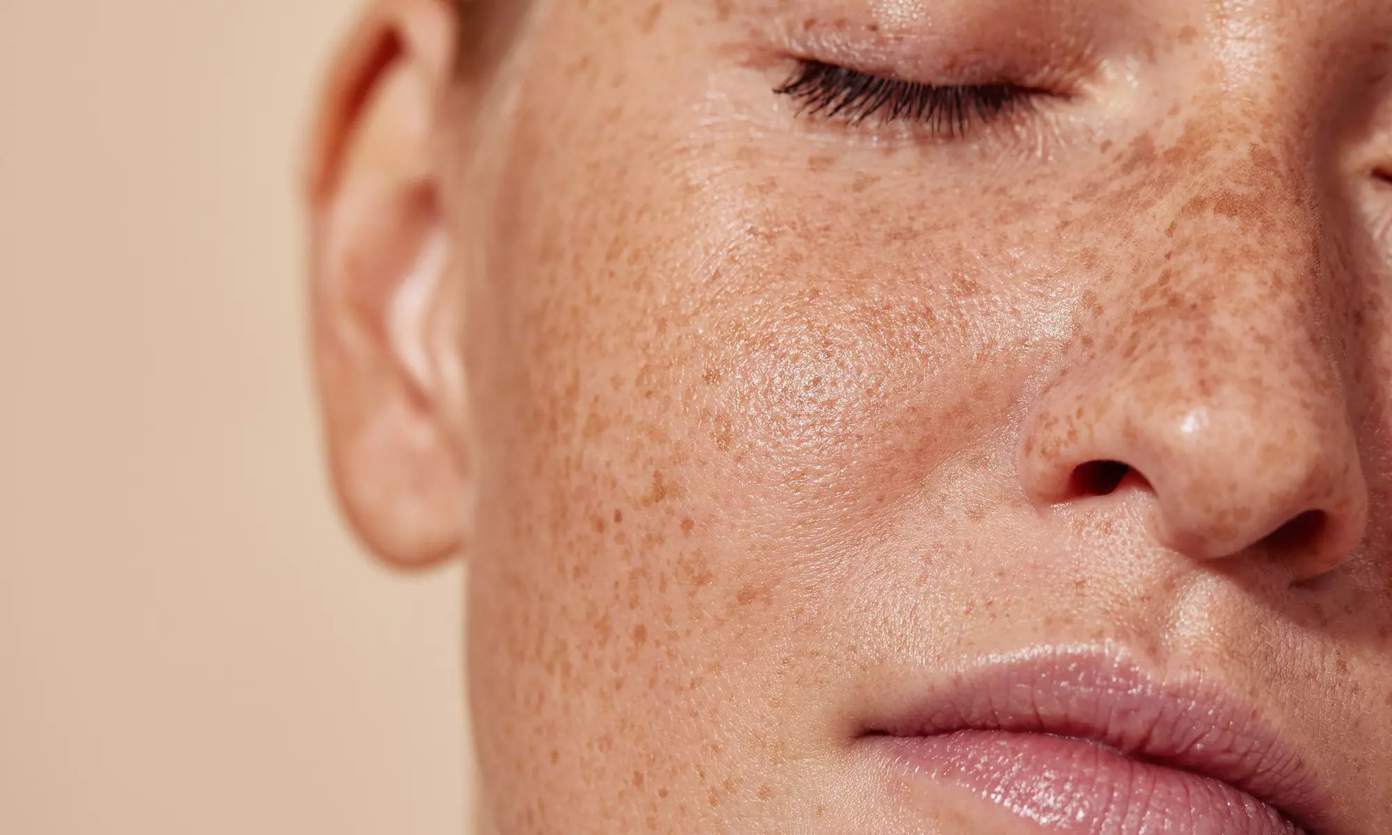 Achieve Youthful Glow with 30 or 40 Units of Botox