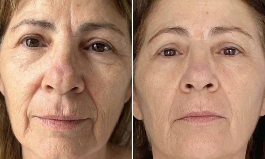 Image 3: One HIFU Non Surgical Facelift Treatment for One Face Zone, Full Face