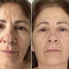Image 3: One HIFU Non Surgical Facelift Treatment for One Face Zone, Full Face