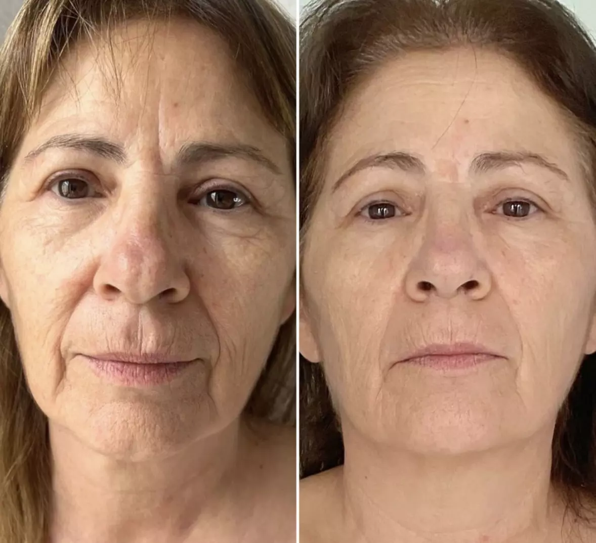 One HIFU Non Surgical Facelift Treatment for One Face Zone, Full Face