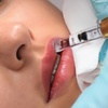 Image 15: Hyaluronpen con hidratación o relleno de labios y reafirmación facial