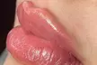 Smooth, Plump, & Perfect: Versa Enhancements at Divaa Beauty (Up to 40% Off) - Second Medium