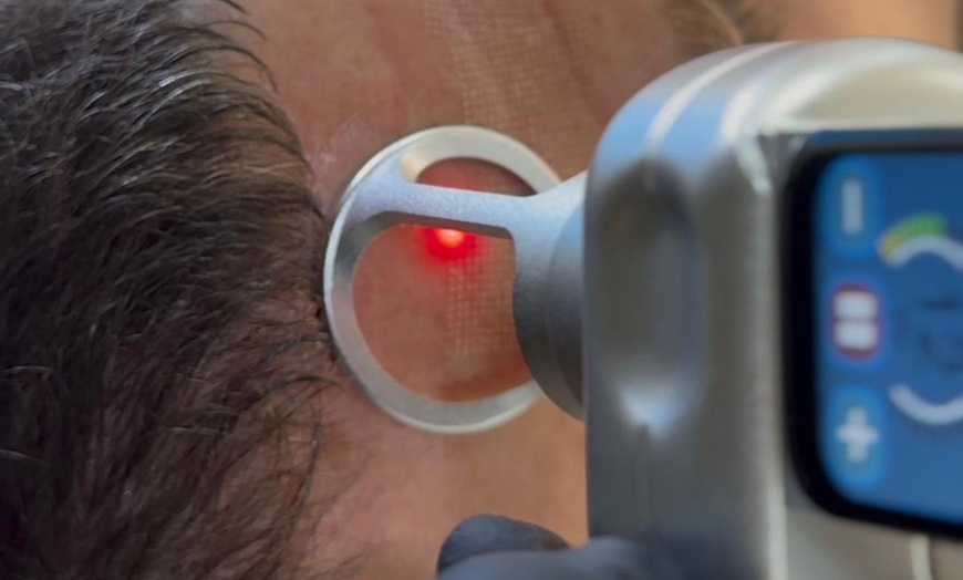 Image 2: 1 o 3 sesiones de rejuvenecimiento facial con láser ‎revitalizante