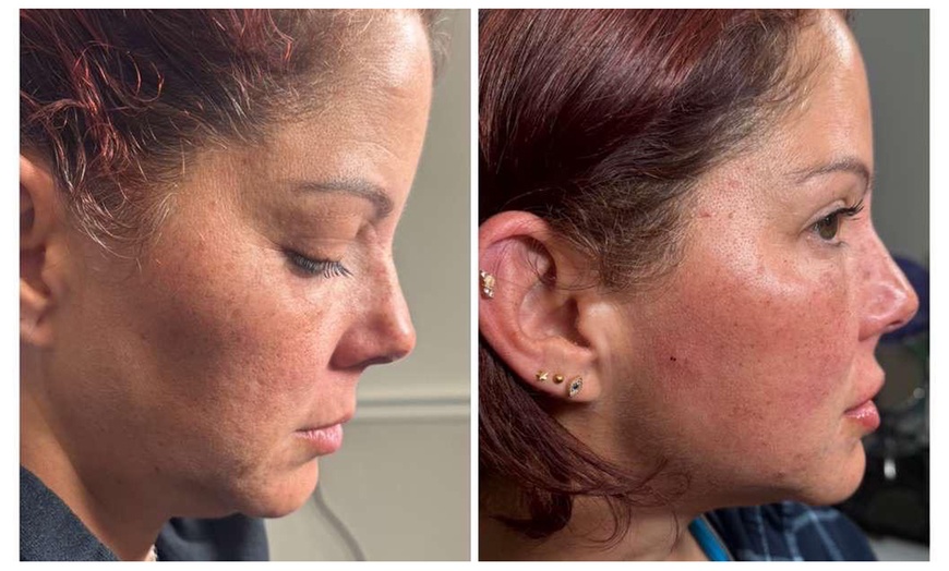 Image 3: Revitalize with Restylane Syringe Options (1.0mL)