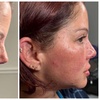 Image 3: Revitalize with Restylane Syringe Options (1.0mL)