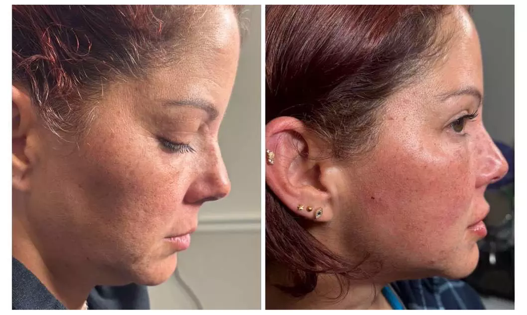 Revitalize with Restylane Syringe Options (1.0mL)