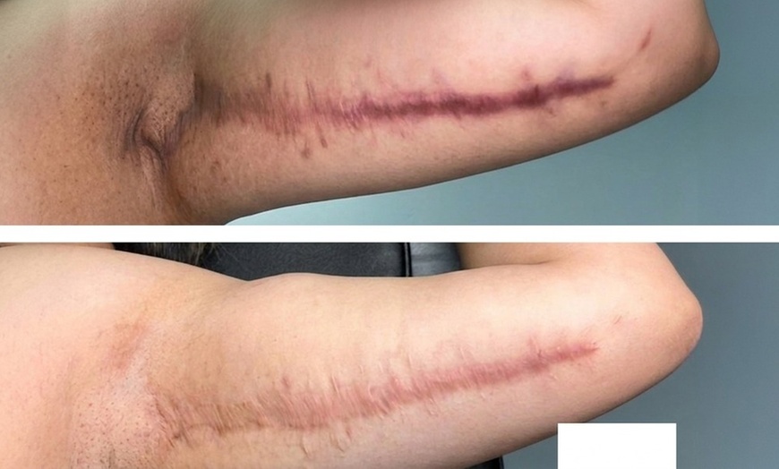 Image 4: Stretch Mark or Scar Treatment - Inkless or Camouflage(Mon-Sat)