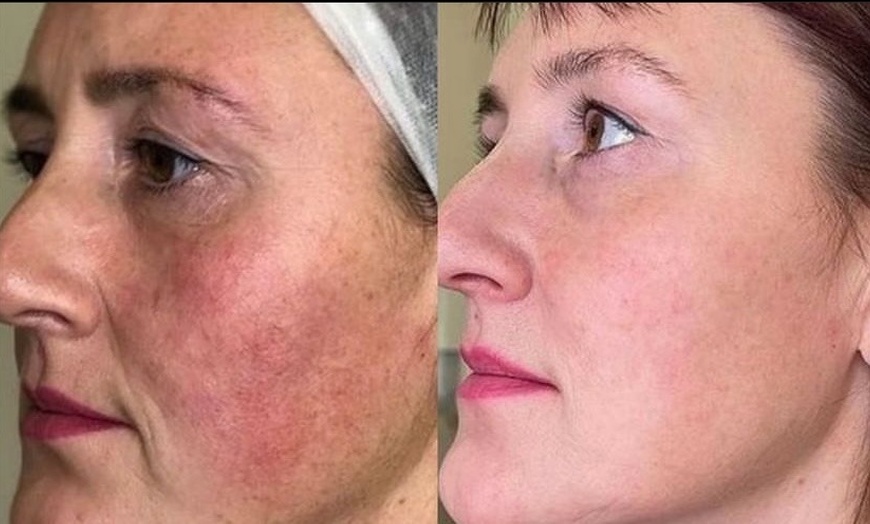 Image 3: Non surgical Face-Lift at Harley Street Facial Aesthetics