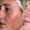 Image 3: Non surgical Face-Lift at Harley Street Facial Aesthetics